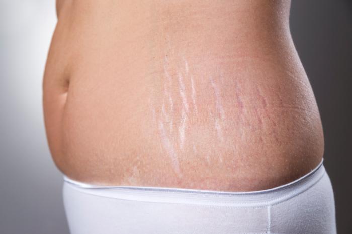 Stretchmark Removal