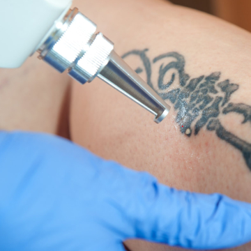 Tattoo Removal